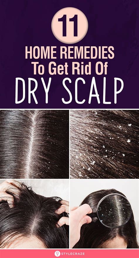 10 Best Home Remedies To Get Rid Of Dry Scalp Dry Scalp Dry Scalp Remedy Treating Dry Hair