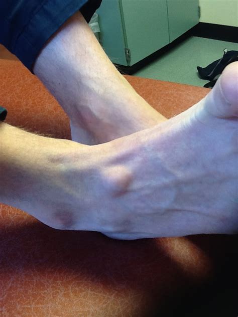 Foot And Ankle Problems By Dr Richard Blake Ganglion Cysts