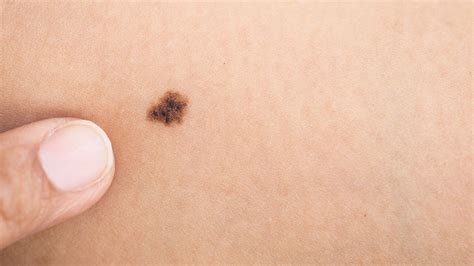More Than 11 Moles On One Arm Could Indicate Higher Risk Of Skin Cancer Huffpost Uk Life