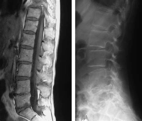 Radiological Features Of Lumbar Spinal Lesions In Patients With