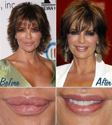 Lisa Rinna Plastic Surgery Before And After Actresses Need To Stop