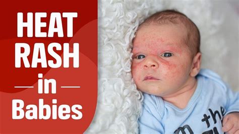 Heat Rash On Baby Back Pictures Heat Rash On Babies Causes