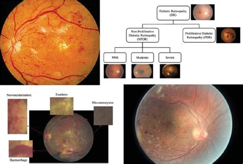 Deep Learning Techniques For Diabetic Retinopathy Detection