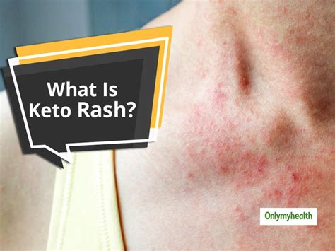 Everything You Need To Know About Keto Rash Onlymyhealth