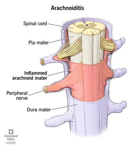 Arachnoiditis What It Is Causes Symptoms And Treatment