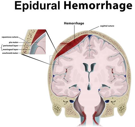 Subdural Vs Epidural Hematoma Symptoms