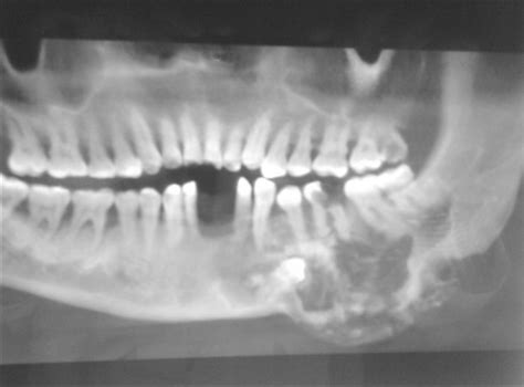 Tumor Odontogênico Epitelial Calcificante Tumor De Pindborg Raios Xis