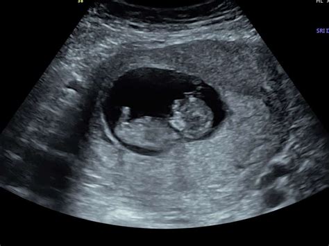 Our Early Scans Explained Window To The Womb