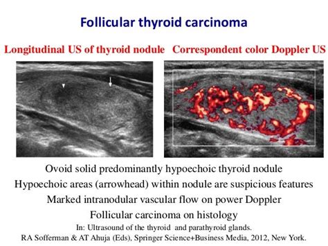 Ultrasound Of Thyroid Nodules