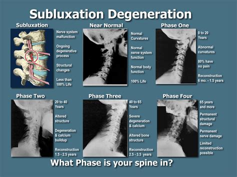 Chiropractic Subluxation Degeneration Poster Chiropractic Etsy