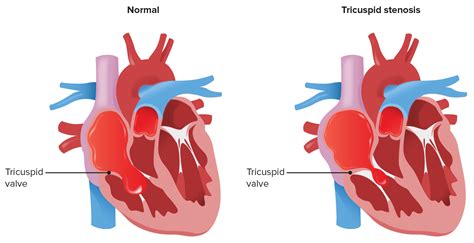 Tricuspid Stenosis Concise Medical Knowledge