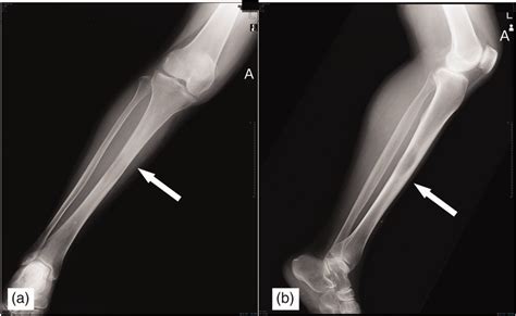 Preoperative Radiographs The Left Tibial Shaft Has Cortical Erosion