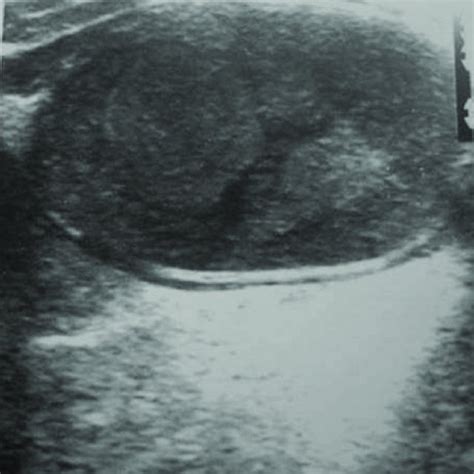 Dermoid Cyst A Sonogram Of The Floor Of Mouth Showing A Well Defined