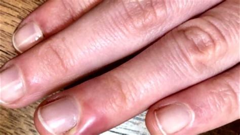 What Is Paronychia Finger Nail Infection Solve Paronychia With