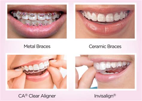 Orthodontics Braces And Aligner Roomchang Mobile Website