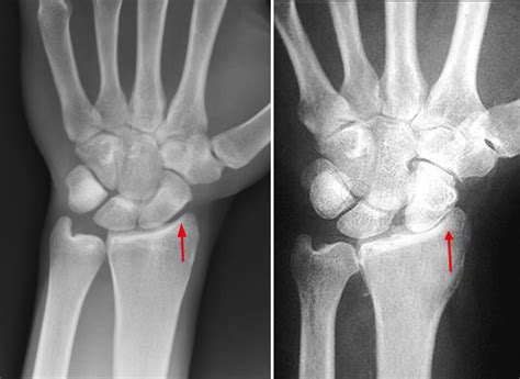 Arthritis Of The Wrist Orthopedic And Sports Medicine