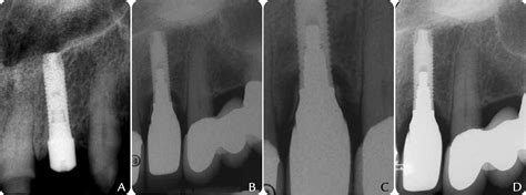 Radiographic Detection And Characteristic Patterns Of Residual Excess