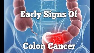 How To Know If You Have Colon Cancer