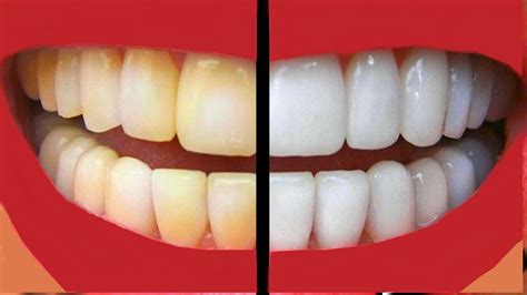 Beberapa cara berbeda untuk cara memutihkan gigi dengan baking soda antara lain baking soda memiliki kemampuan abrasif yang dapat membantu cara memutihkan gigi. Begini Cara Memutihkan Gigi dengan 8 Bahan Alami | Info ...