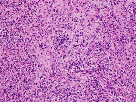 Pathology Outlines Angiofibroma