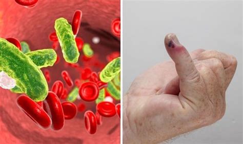 Bacterial infections cause most cases of sepsis. Sepsis symptoms: What causes sepsis? How to prevent the deadly condition | Express.co.uk