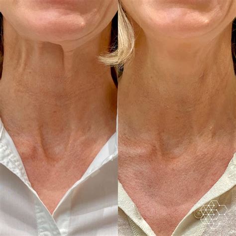 Top Treatments For The Neck And Chest Skin Technique