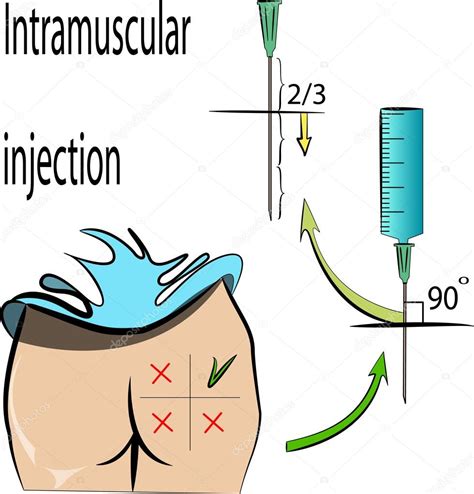 Image Vectorielle Injection Intramusculaire Par Artemida Psy