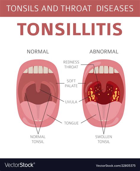 Tonsillitis Diagram