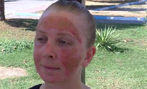 Woman Has 2nd Degree Burns On Face After Skin Treatment Viraltab