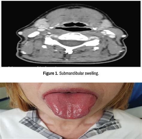 Figure 1 From Chronic Swelling Of The Submandibular Glands And Sicca