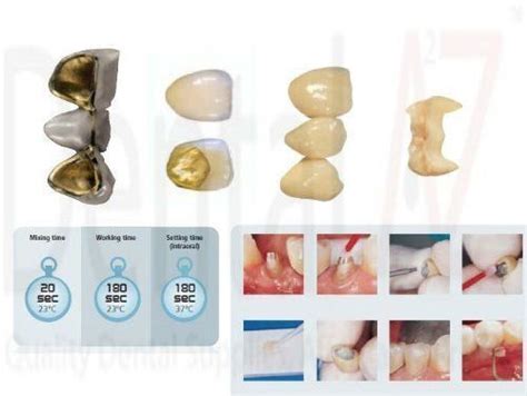 Automix Permanent Dental Cement For Caps Crown Bridges Inlays Onlays