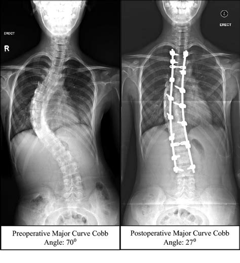 Case Example Of An Adolescent Idiopathic Scoliosis Patient With