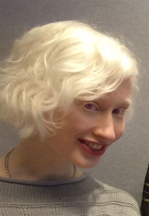 About Albinism Albinism Fellowship Of Australia