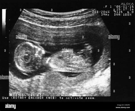 Ultrasound Of A 3 Month Old Fetus Stock Photo 37387241 Alamy
