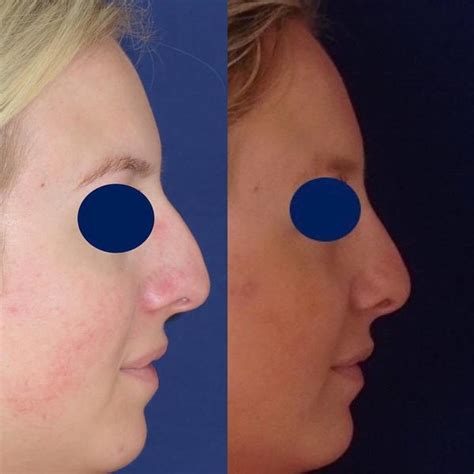 Removing A Dorsal Hump Before And After 1 Rhinoplasty Cost Pics