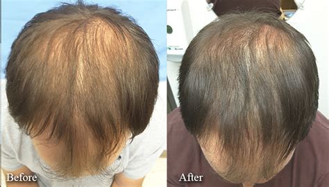 Prp Treatment Before And After Male Limmer Hair Transplant Center