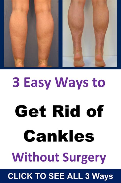 How To Get Rid Of Cankles Fast → Get Skinny Ankles Without Surgery