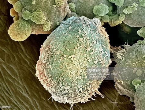 Lymphoma Lymph Cell Closeup High Res Stock Photo Getty Images