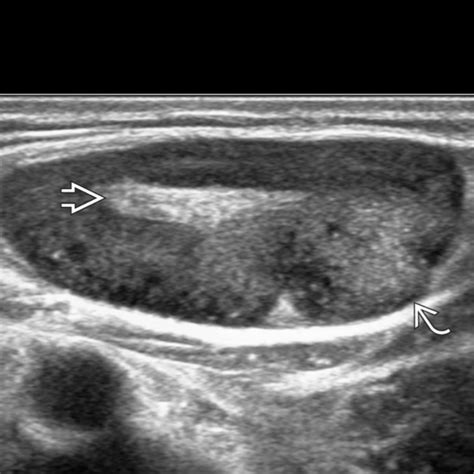 Swollen Lymph Node Ultrasound