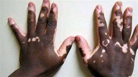 Vitiligo Causas Y Tratamiento Para Las Manchas Blancas En La Piel