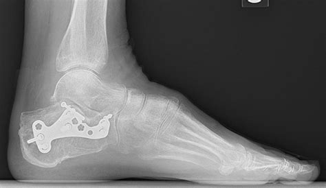 Calcaneus Fracture Surgery Heel Surgery Footcaremd