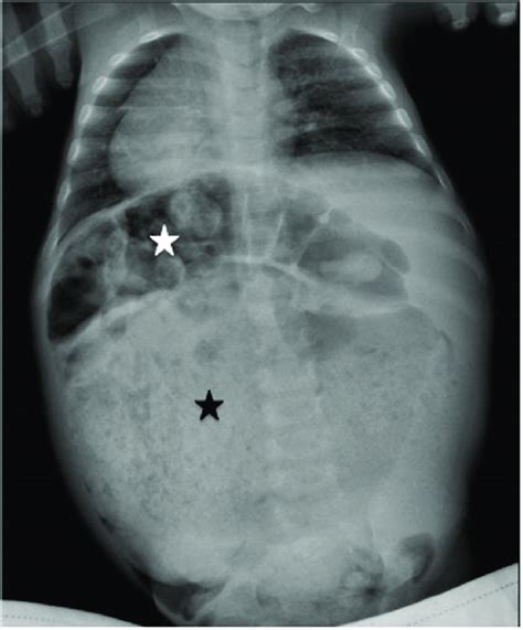 Abdominal X Ray Showing Huge Fecal Impaction Black Star Associated