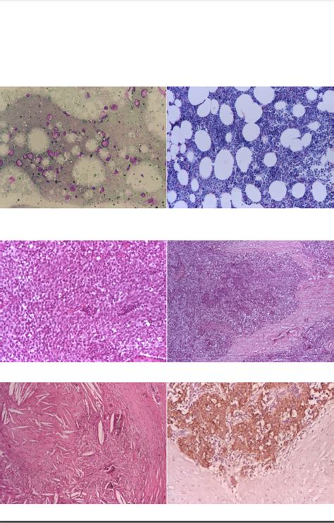 Acquired Aplastic Anemia Correlation Between Etiology Pathophysiology