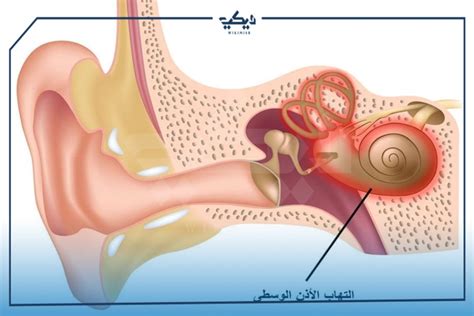 اعراض التهاب الاذن ما هي وأسباب التهاب الأذن ويكي مصر