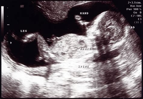 17 Weeks Pregnant Symptoms Ultrasound And Fetus Development