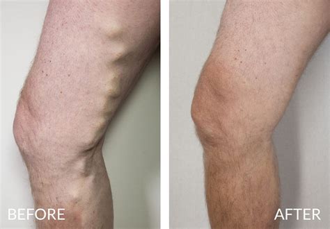 Varicose Veins Removal Private Treatment Southwest Veins