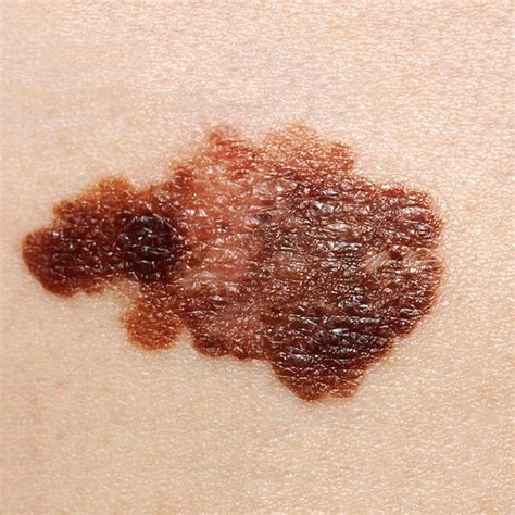 Photo Gallery Of Skin Cancer By Type