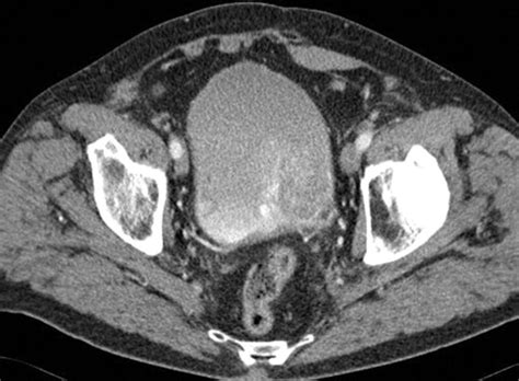Urinary Bladder Cancer Role Of Mr Imaging Radiographics