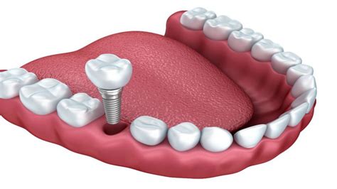 Dental Implants In Virginia Beach Lakeshore Dental