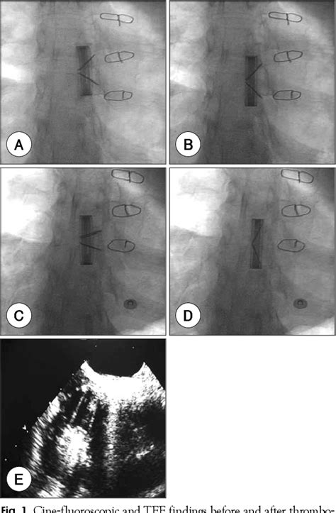 Figure 1 From Thrombolysis In The Obstructed Prosthetic Tricuspid Valve